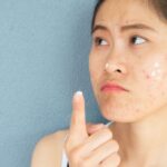 Acne Scar Removal in Kolkata