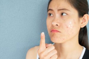 Acne Scar Removal in Kolkata