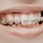Adult orthodontics