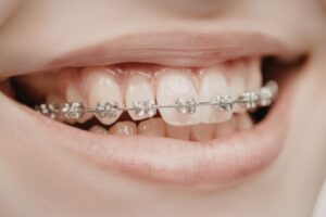 Adult orthodontics